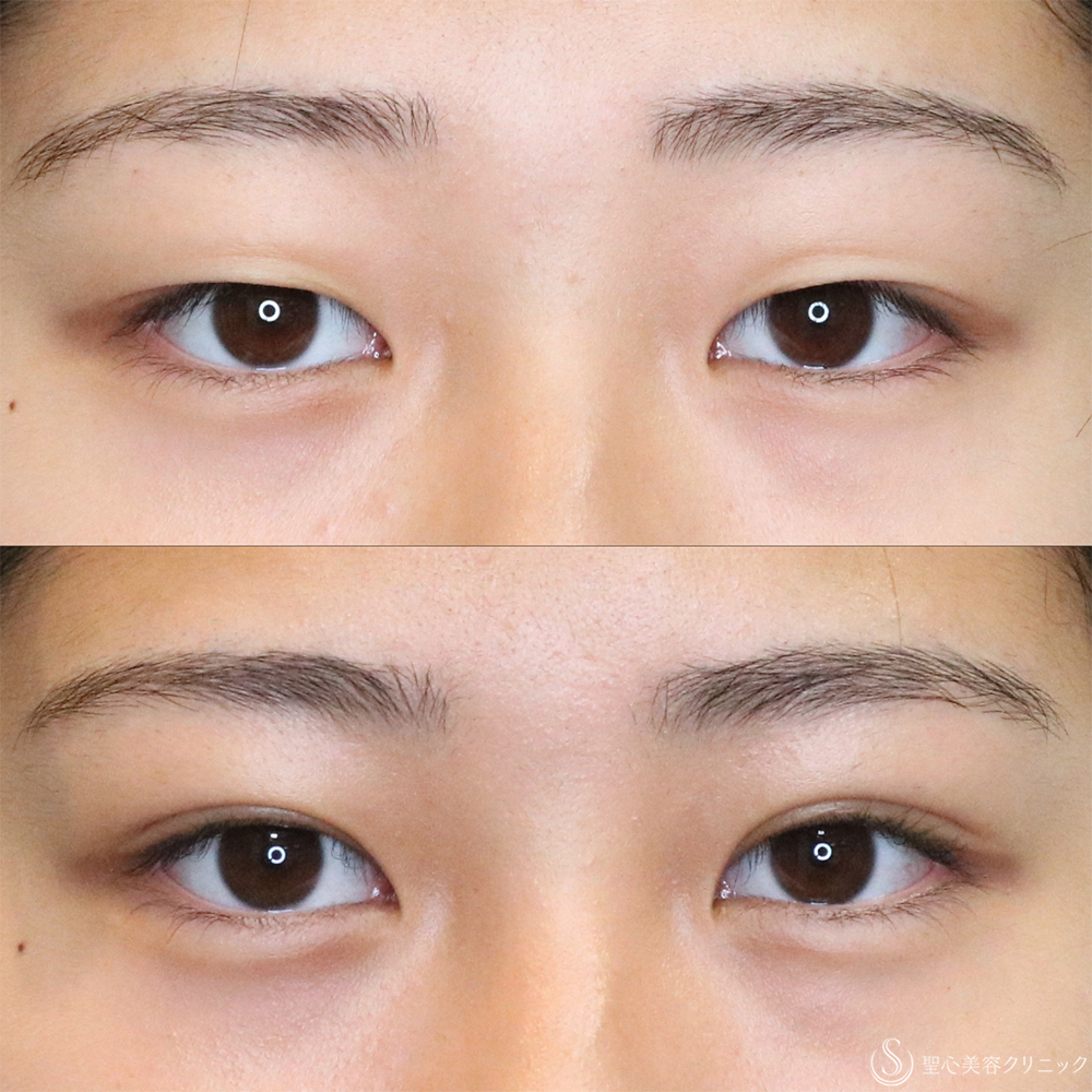 【10代女性・自然な二重に】二重埋没法（ダブルノット法）（1ヶ月後） After 名古屋・二重・埋没法