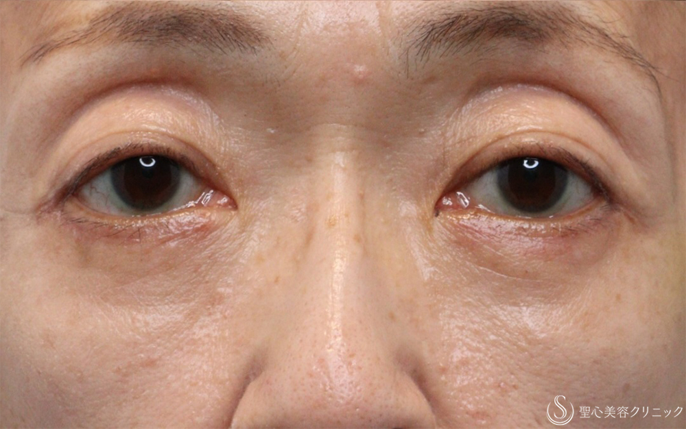 【60代女性・目の下のクマ】ハムラ法（1ヶ月後） After 