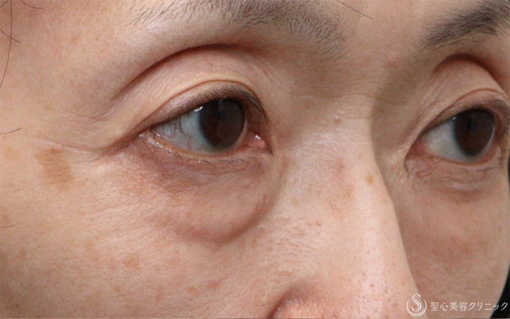 【60代女性・目の下のクマ】ハムラ法（1ヶ月後） Before 