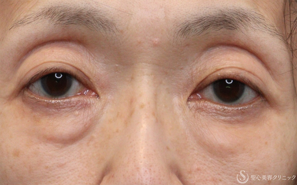 【60代女性・目の下のクマ】ハムラ法（1ヶ月後） Before 