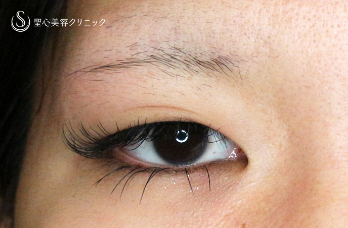 【20代女性・理想の二重をつくる】二重全切開+α法「Ver.5.5」（術直後〜1ヶ月後） Before 