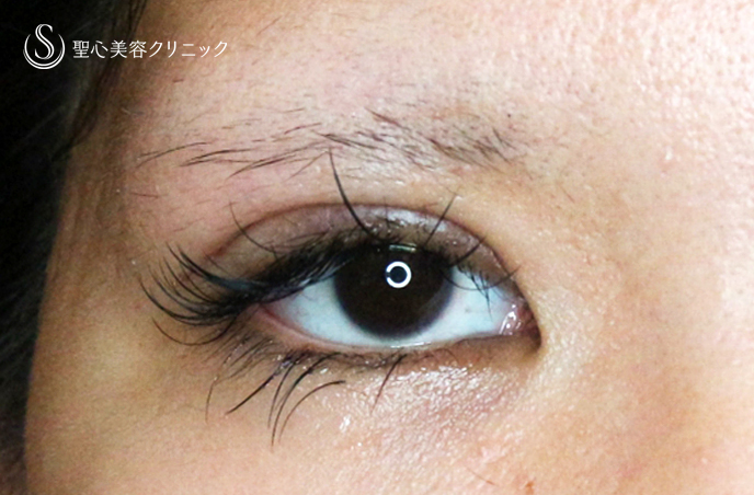 【20代女性・理想の二重をつくる】二重全切開+α法「Ver.5.5」（術直後〜1ヶ月後） Before 