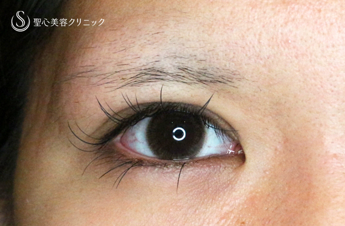 【20代女性・理想の二重をつくる】二重全切開+α法「Ver.5.5」（術直後〜1ヶ月後） After 