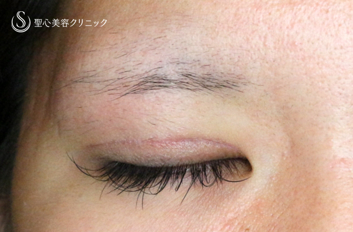 【20代女性・理想の二重をつくる】二重全切開+α法「Ver.5.5」（術直後〜1ヶ月後） After 