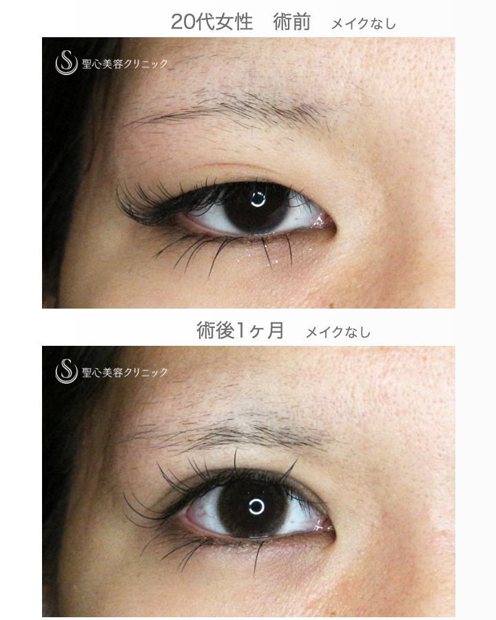 【20代女性・理想の二重をつくる】二重全切開+α法「Ver.5.5」（術直後〜1ヶ月後） After 