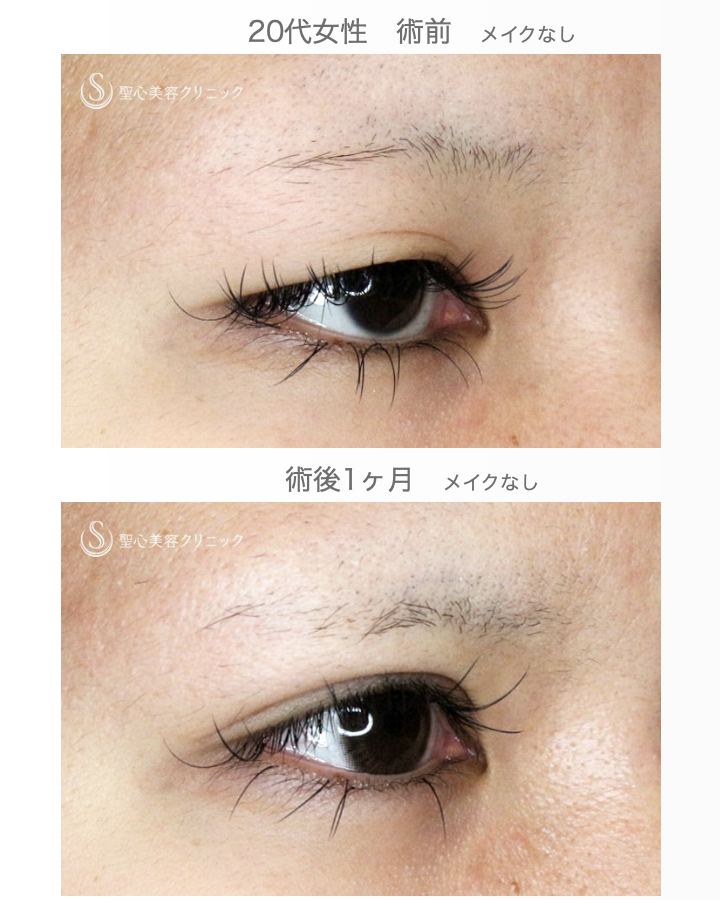 【20代女性・理想の二重をつくる】二重全切開+α法「Ver.5.5」（術直後〜1ヶ月後） After 