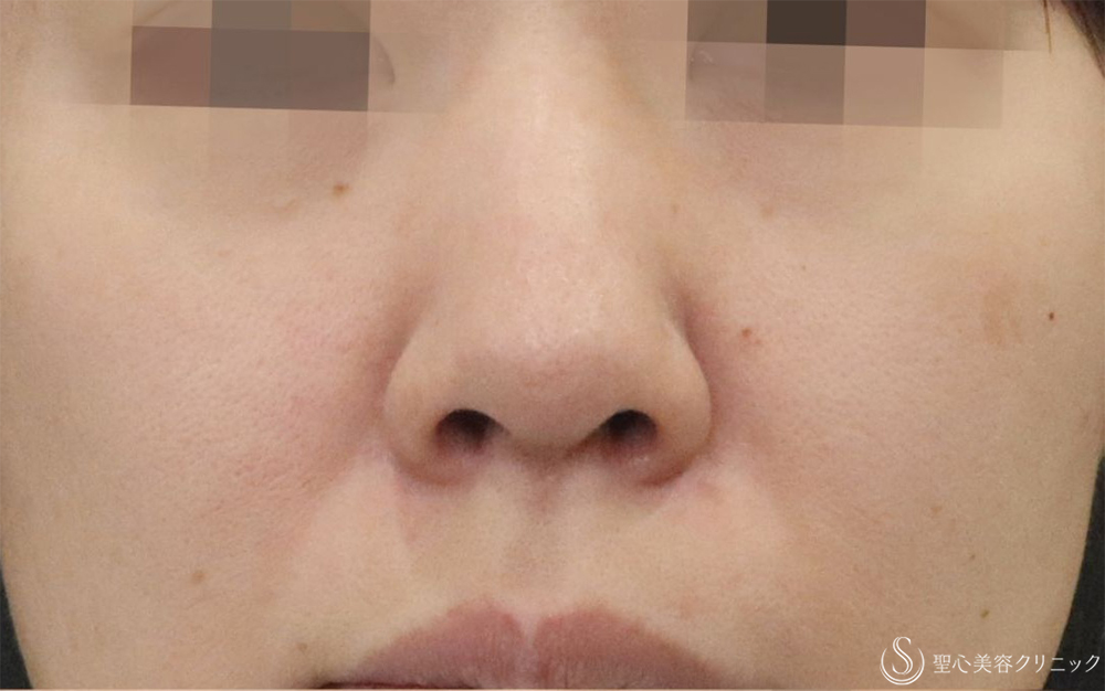 【40代女性・鼻先を目立たなくする】鼻尖縮小＋耳介軟骨＋Gメッシュ3本（1週間後） Before 