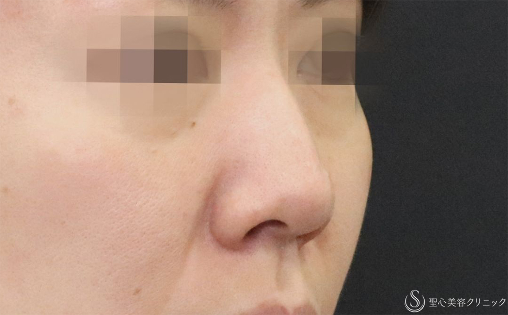 【40代女性・鼻先を目立たなくする】鼻尖縮小＋耳介軟骨＋Gメッシュ3本（1週間後） Before 