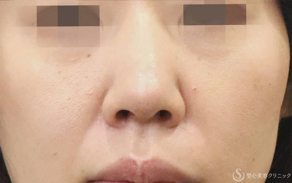 【40代女性・鼻先を目立たなくする】鼻尖縮小＋耳介軟骨＋Gメッシュ3本（1週間後） After 