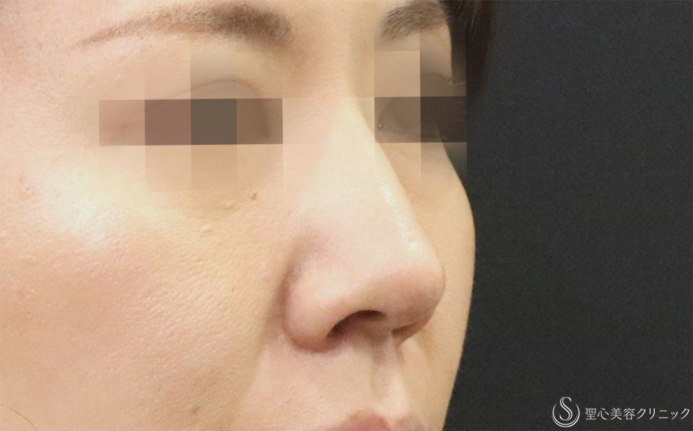 【40代女性・鼻先を目立たなくする】鼻尖縮小＋耳介軟骨＋Gメッシュ3本（1週間後） After 