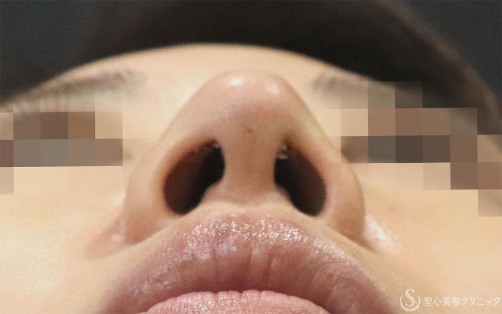 【40代女性・鼻先を目立たなくする】鼻尖縮小＋耳介軟骨＋Gメッシュ3本（1週間後） After 