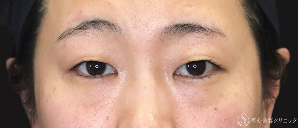 【20代女性・切開法で二重に】二重切開（4ヶ月後） Before 