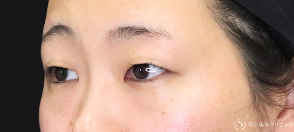 【20代女性・切開法で二重に】二重切開（4ヶ月後） Before 