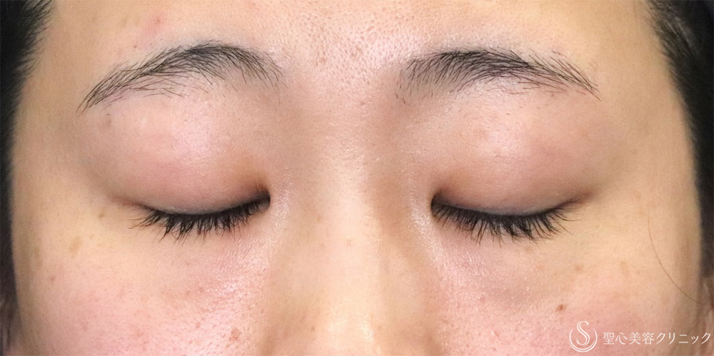 【20代女性・切開法で二重に】二重切開（4ヶ月後） Before 