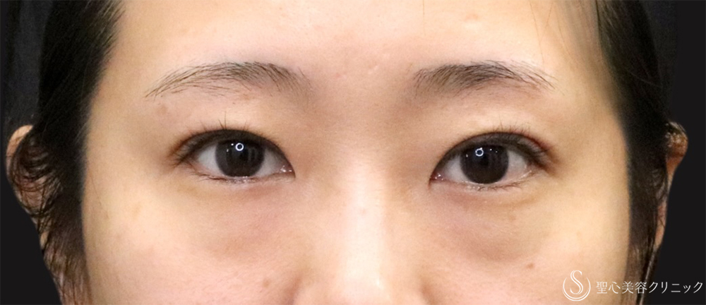 【20代女性・切開法で二重に】二重切開（4ヶ月後） After 