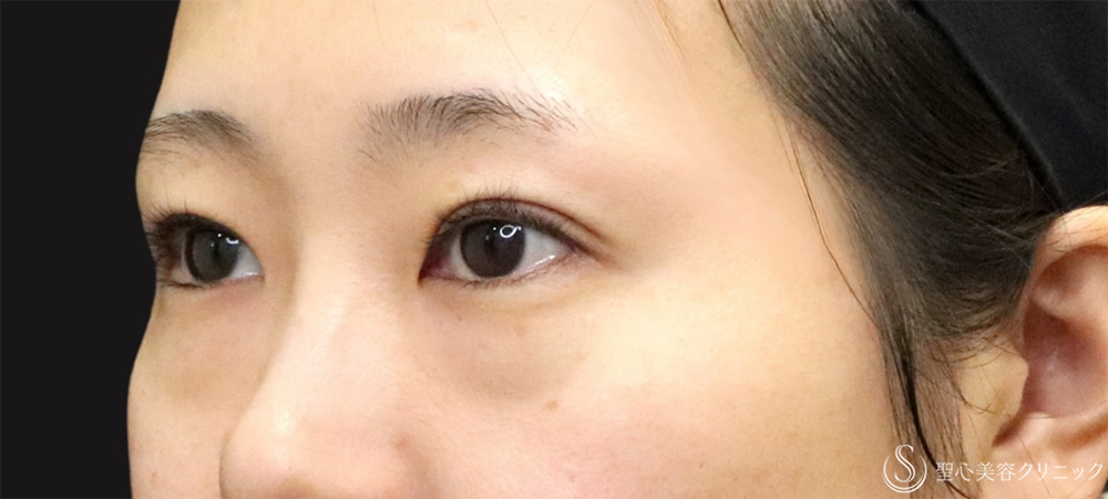 【20代女性・切開法で二重に】二重切開（4ヶ月後） After 