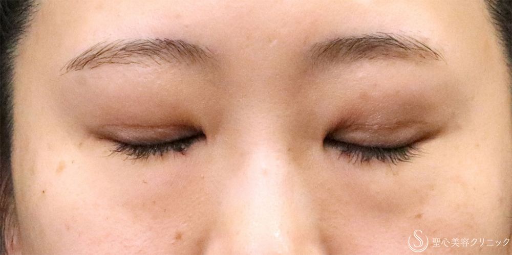 【20代女性・切開法で二重に】二重切開（4ヶ月後） After 