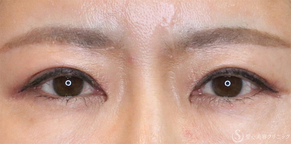 【50代女性・まぶたすっきり】眉下切開法（眉下リフト）（3ヶ月後） After 名古屋・まぶたのたるみ取り・目の上のたる眉下切開