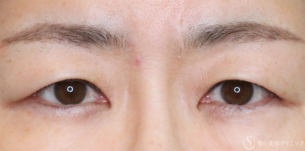 【50代女性・まぶたすっきり】眉下切開法（眉下リフト）（3ヶ月後） Before 名古屋・まぶたのたるみ取り・目の上のたる眉下切開