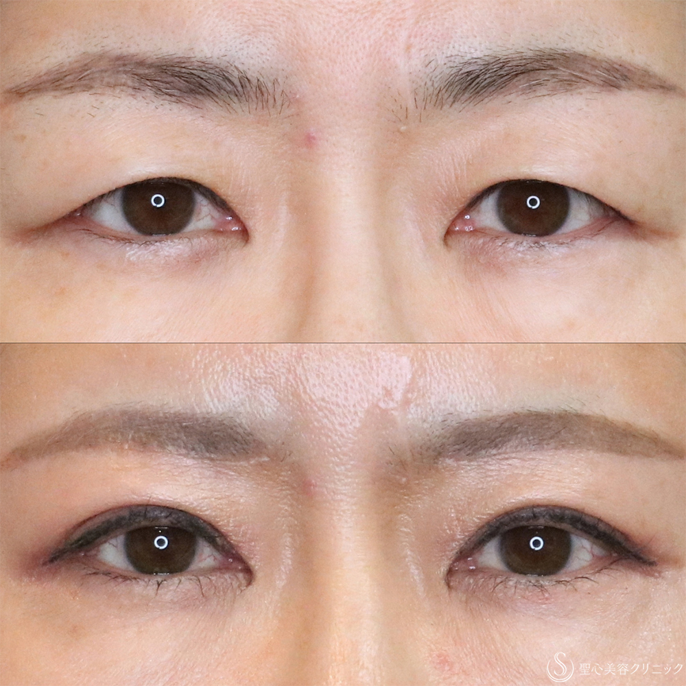 【50代女性・まぶたすっきり】眉下切開法（眉下リフト）（3ヶ月後） After 名古屋・まぶたのたるみ取り・目の上のたる眉下切開