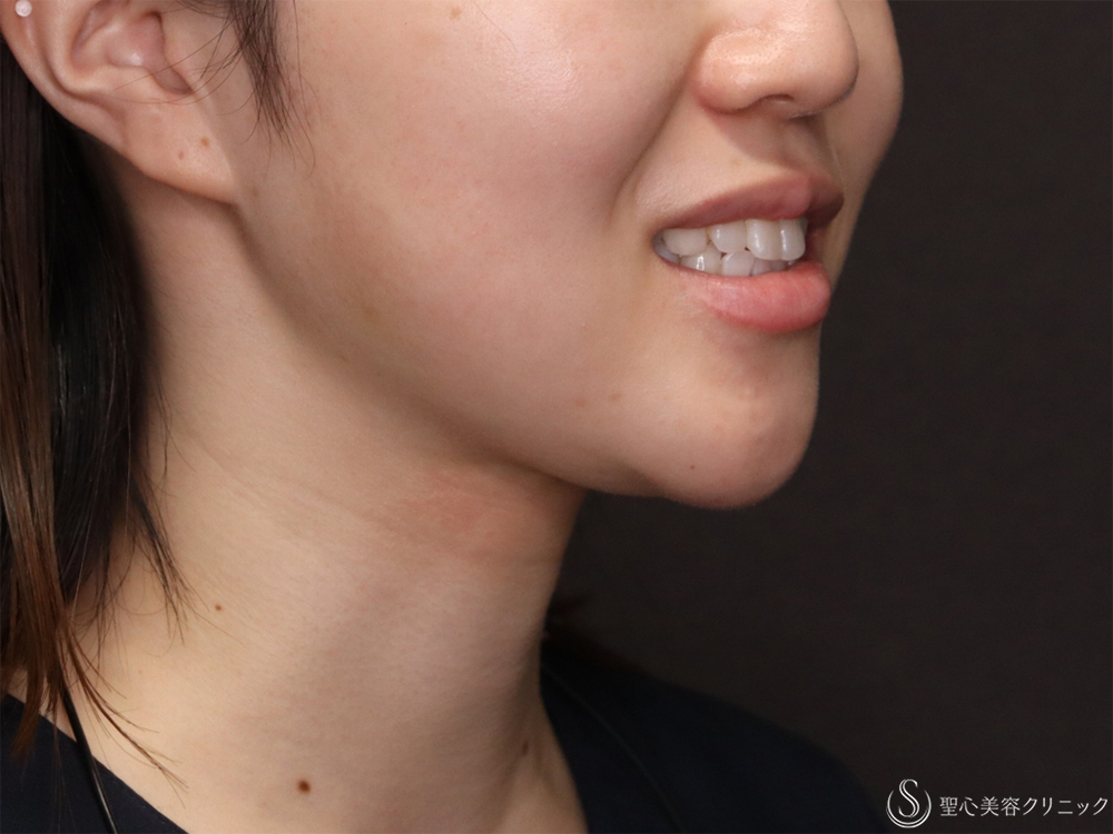 【20代女性・フェイスライン】ボトックスリフト（2週間後） After 