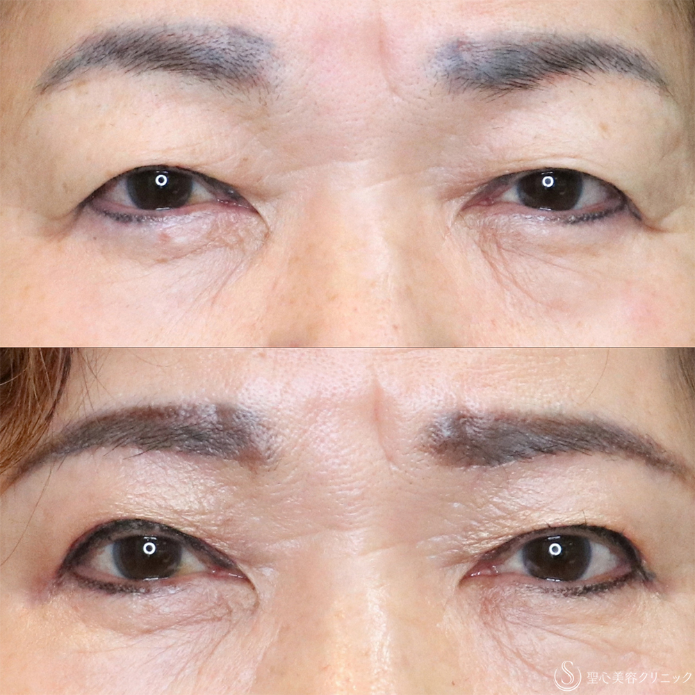 【70代女性・まぶたすっきり】眉下切開法（眉下リフト）＋目上切開法（1ヶ月後） After 名古屋・瞼のたるみ取り・眉下切開・目上切開
