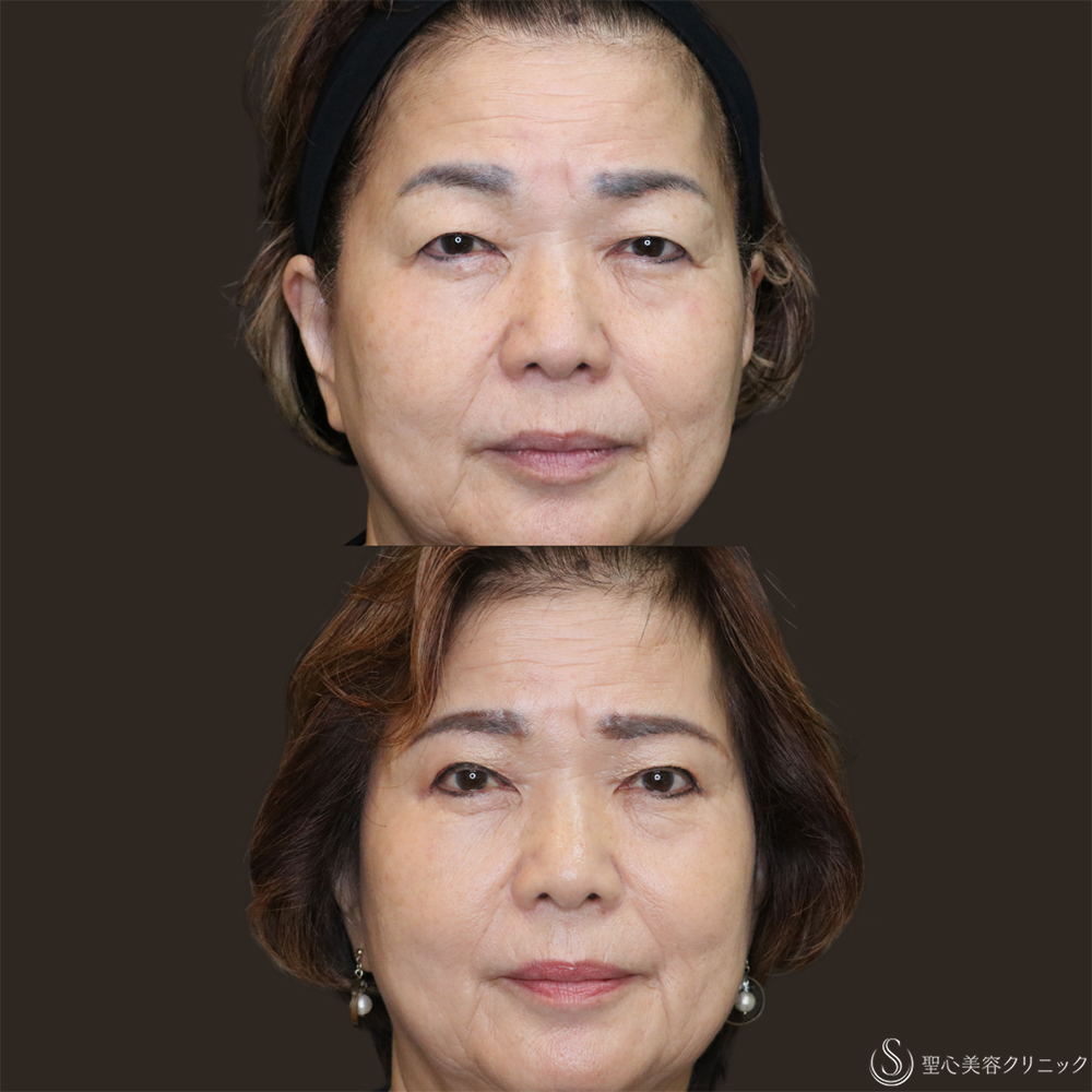 【70代女性・まぶたすっきり】眉下切開法（眉下リフト）＋目上切開法（1ヶ月後） After 名古屋・瞼のたるみ取り・眉下切開・目上切開