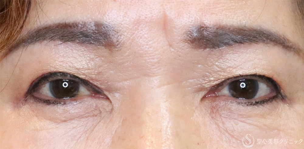 【70代女性・まぶたすっきり】眉下切開法（眉下リフト）＋目上切開法（1ヶ月後） After 名古屋・瞼のたるみ取り・眉下切開・目上切開