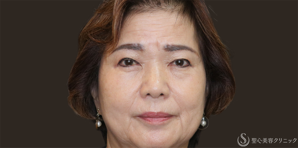 【70代女性・まぶたすっきり】眉下切開法（眉下リフト）＋目上切開法（1ヶ月後） After 名古屋・瞼のたるみ取り・眉下切開・目上切開