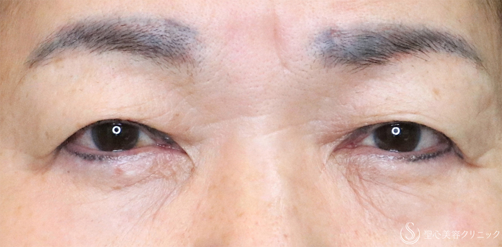 【70代女性・まぶたすっきり】眉下切開法（眉下リフト）＋目上切開法（1ヶ月後） Before 名古屋・瞼のたるみ取り・眉下切開・目上切開