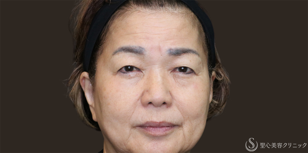 【70代女性・まぶたすっきり】眉下切開法（眉下リフト）＋目上切開法（1ヶ月後） Before 名古屋・瞼のたるみ取り・眉下切開・目上切開
