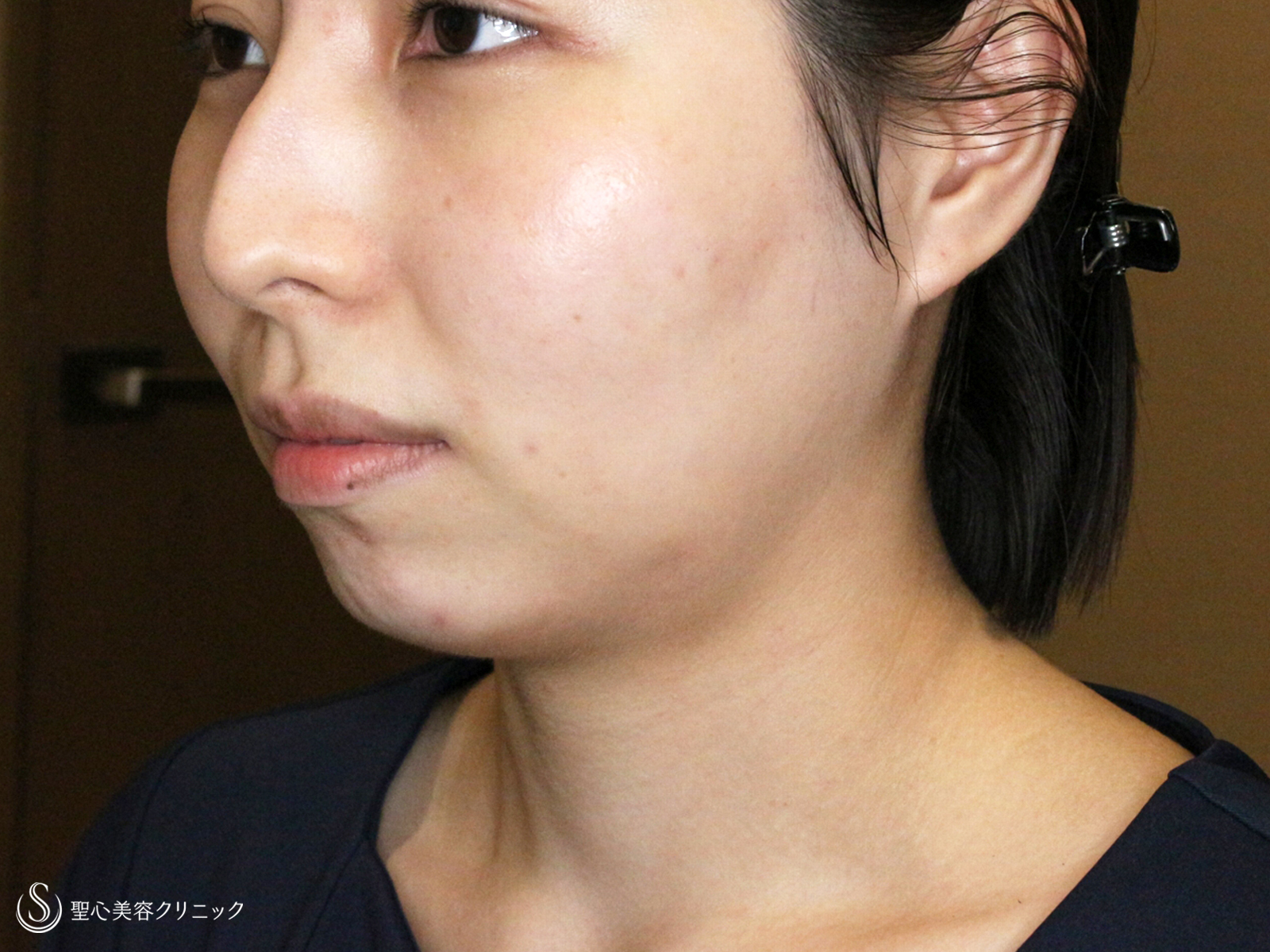 【30代女性・札幌院スタッフ①】あご下の脂肪吸引注射（術直後〜1ヶ月後） Before 