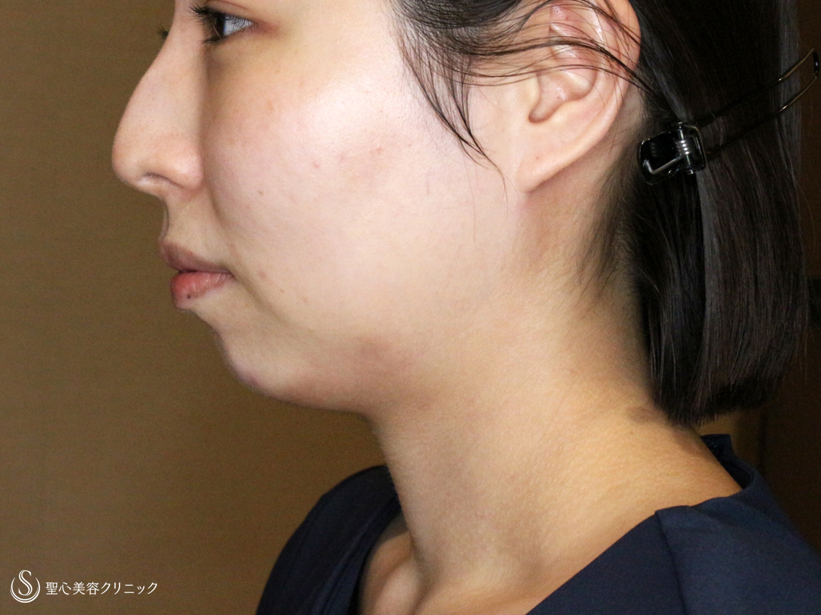 【30代女性・札幌院スタッフ①】あご下の脂肪吸引注射（術直後〜1ヶ月後） Before 