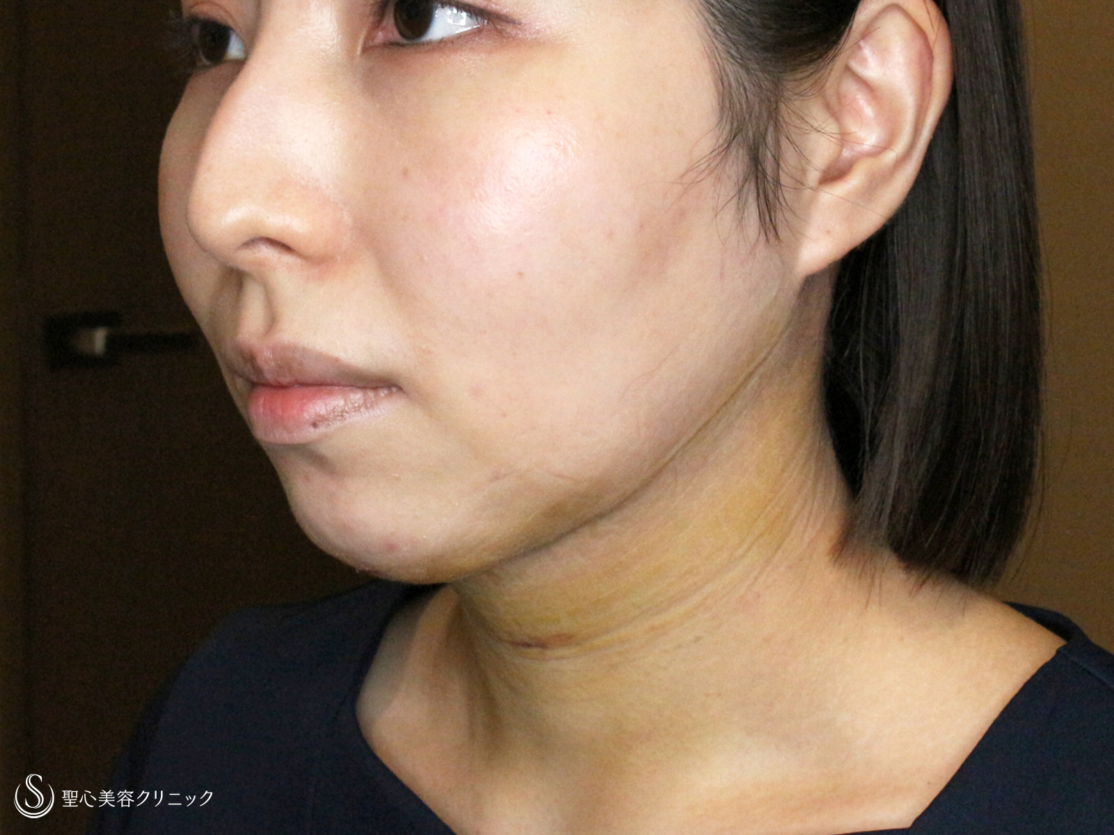 【30代女性・札幌院スタッフ①】あご下の脂肪吸引注射（術直後〜1ヶ月後） After 