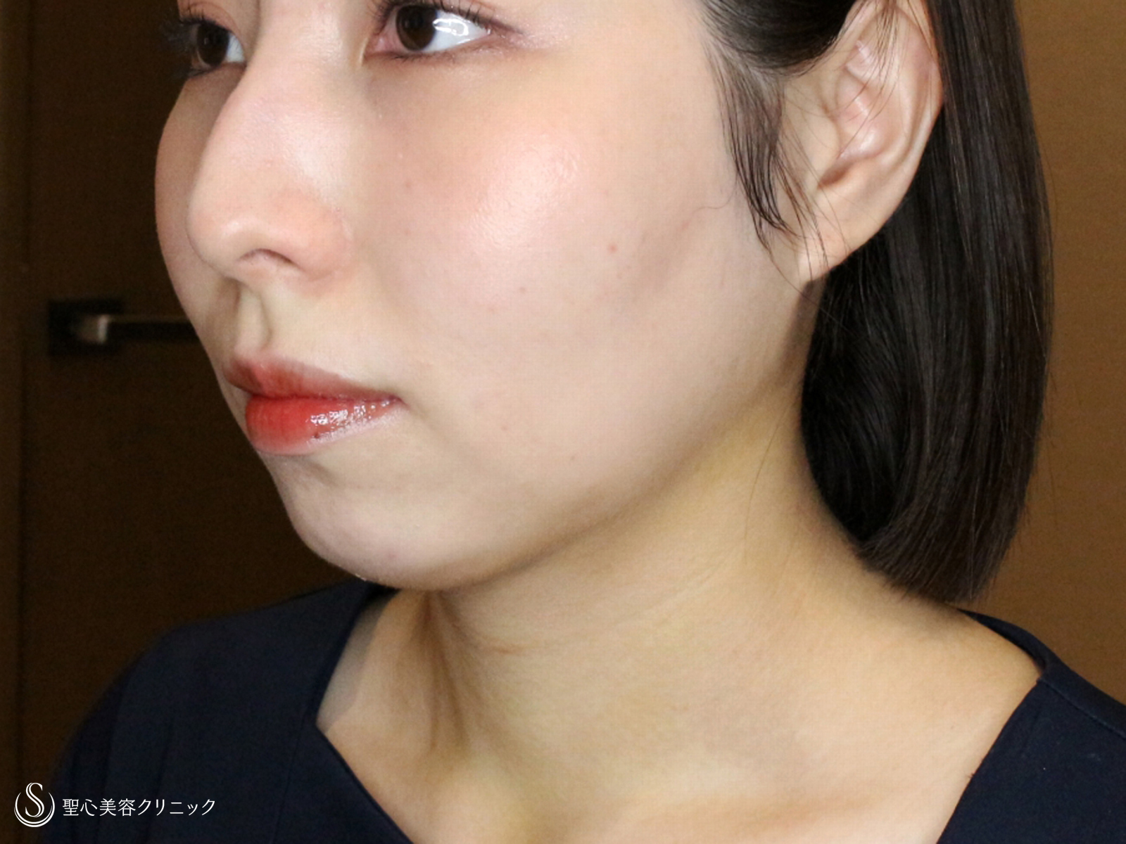 【30代女性・札幌院スタッフ①】あご下の脂肪吸引注射（術直後〜1ヶ月後） After 