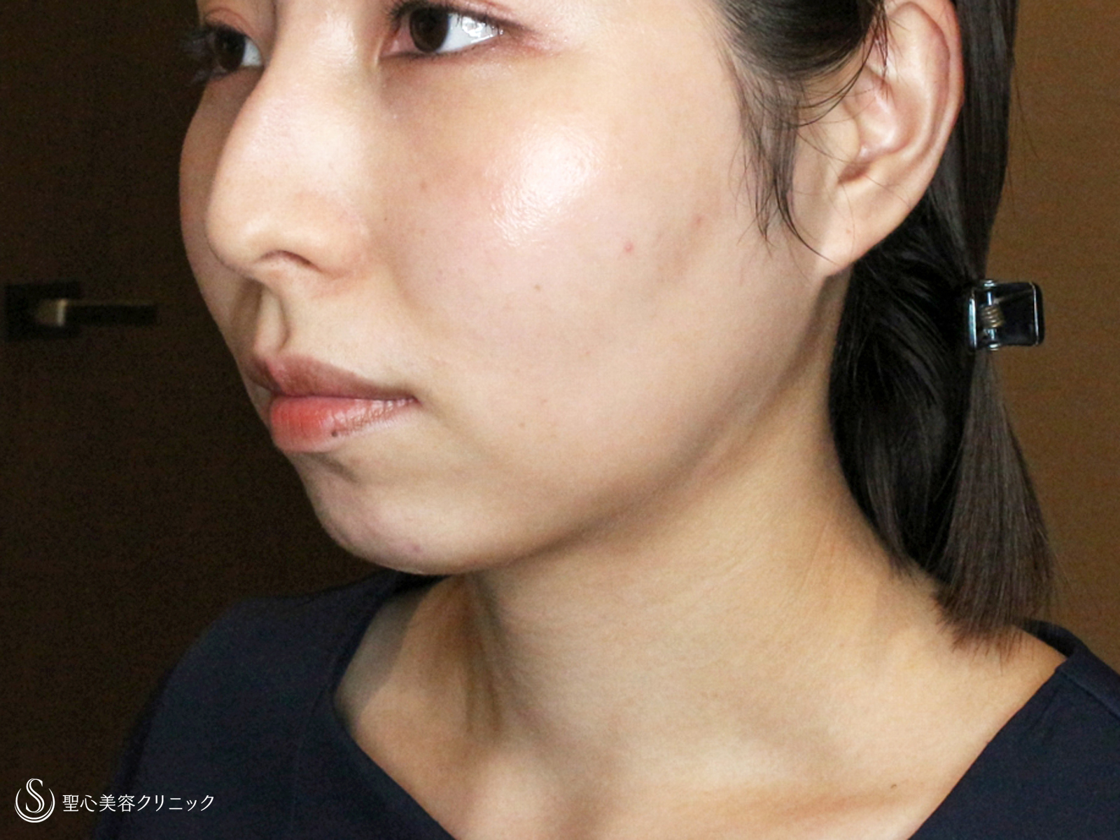 【30代女性・札幌院スタッフ①】あご下の脂肪吸引注射（術直後〜1ヶ月後） After 