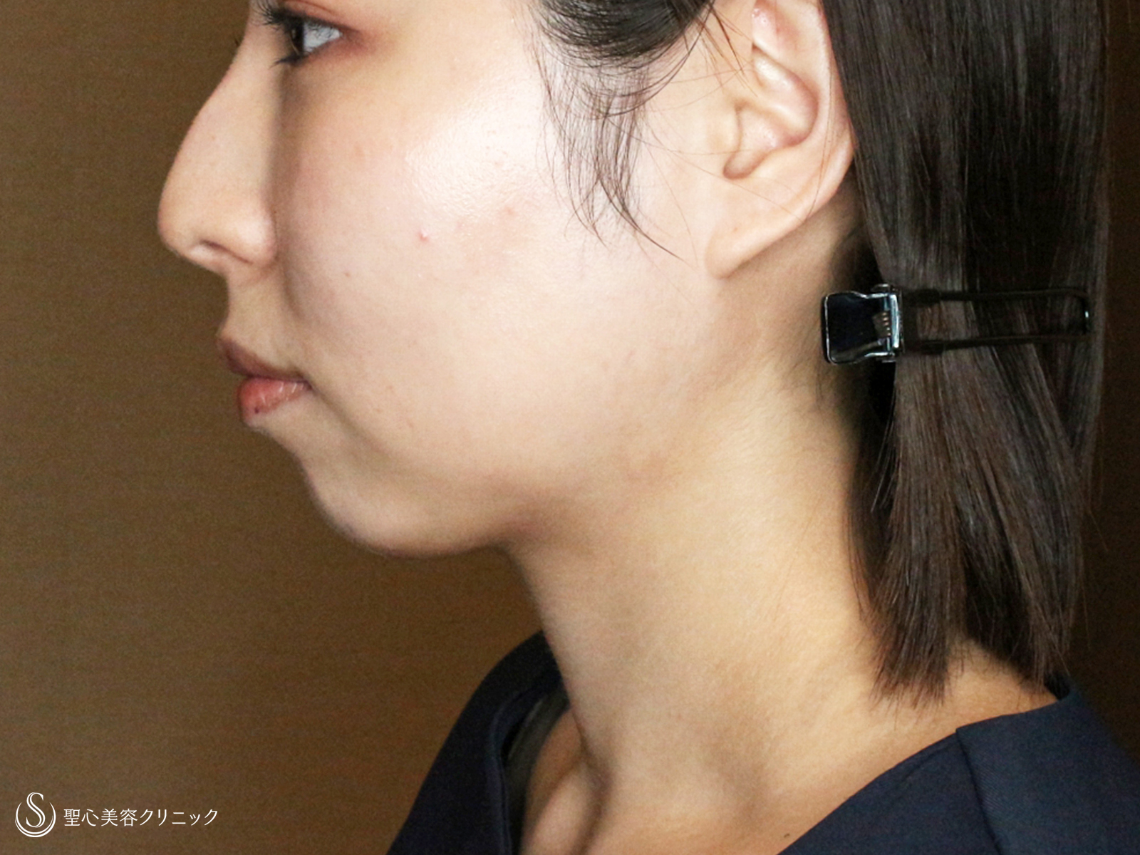 【30代女性・札幌院スタッフ①】あご下の脂肪吸引注射（術直後〜1ヶ月後） After 