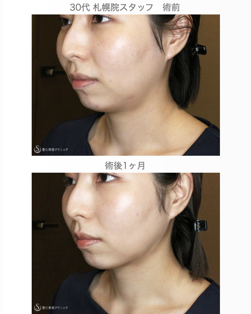 【30代女性・札幌院スタッフ①】あご下の脂肪吸引注射（術直後〜1ヶ月後） After 