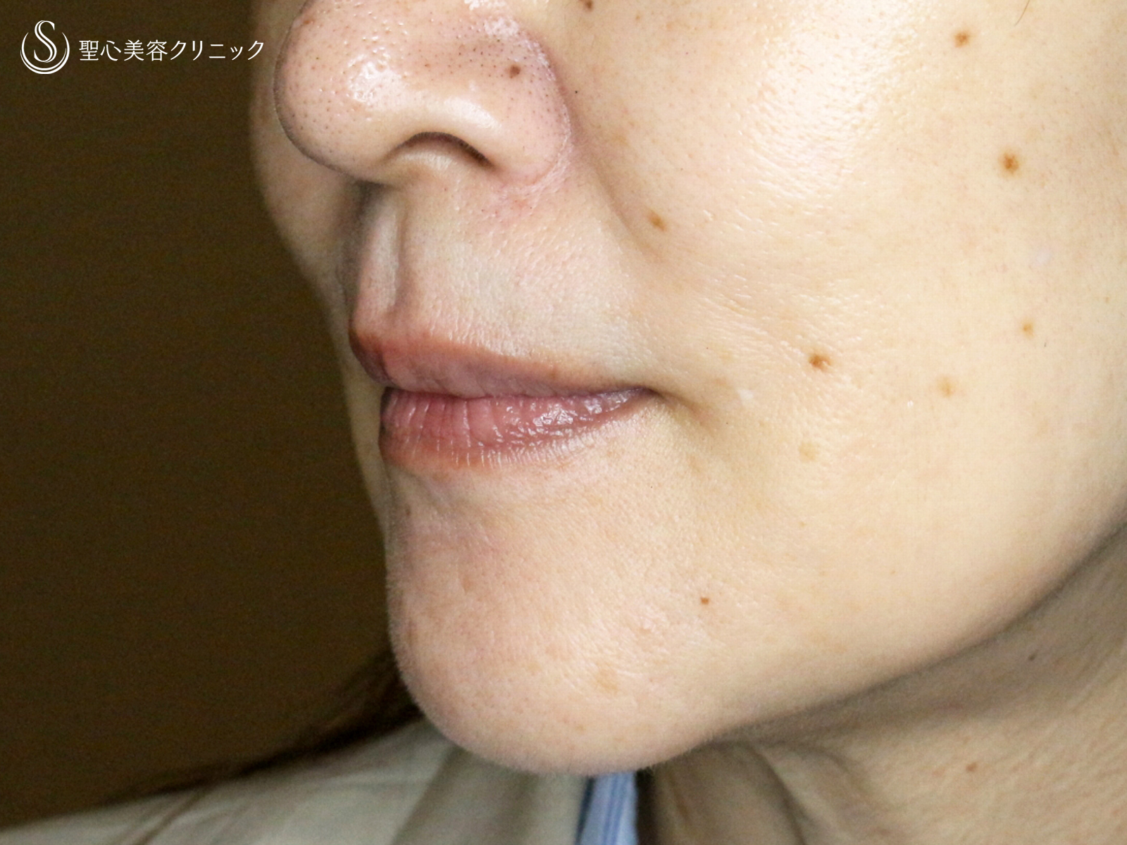 【60代女性・口元の若返り】スマイルリップ「ヒアルロン酸注入」（処置直後） Before 