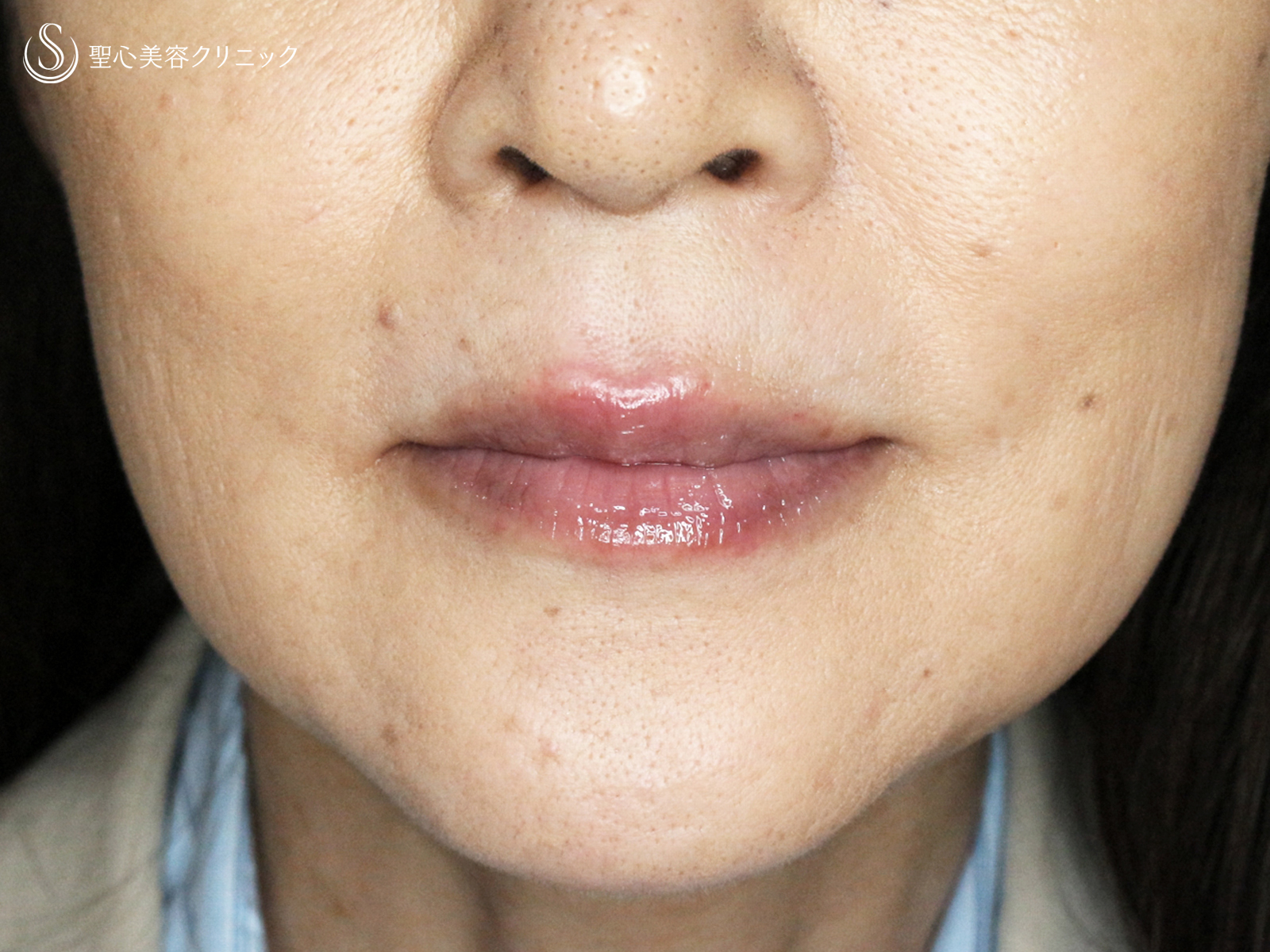 【60代女性・口元の若返り】スマイルリップ「ヒアルロン酸注入」（処置直後） After 