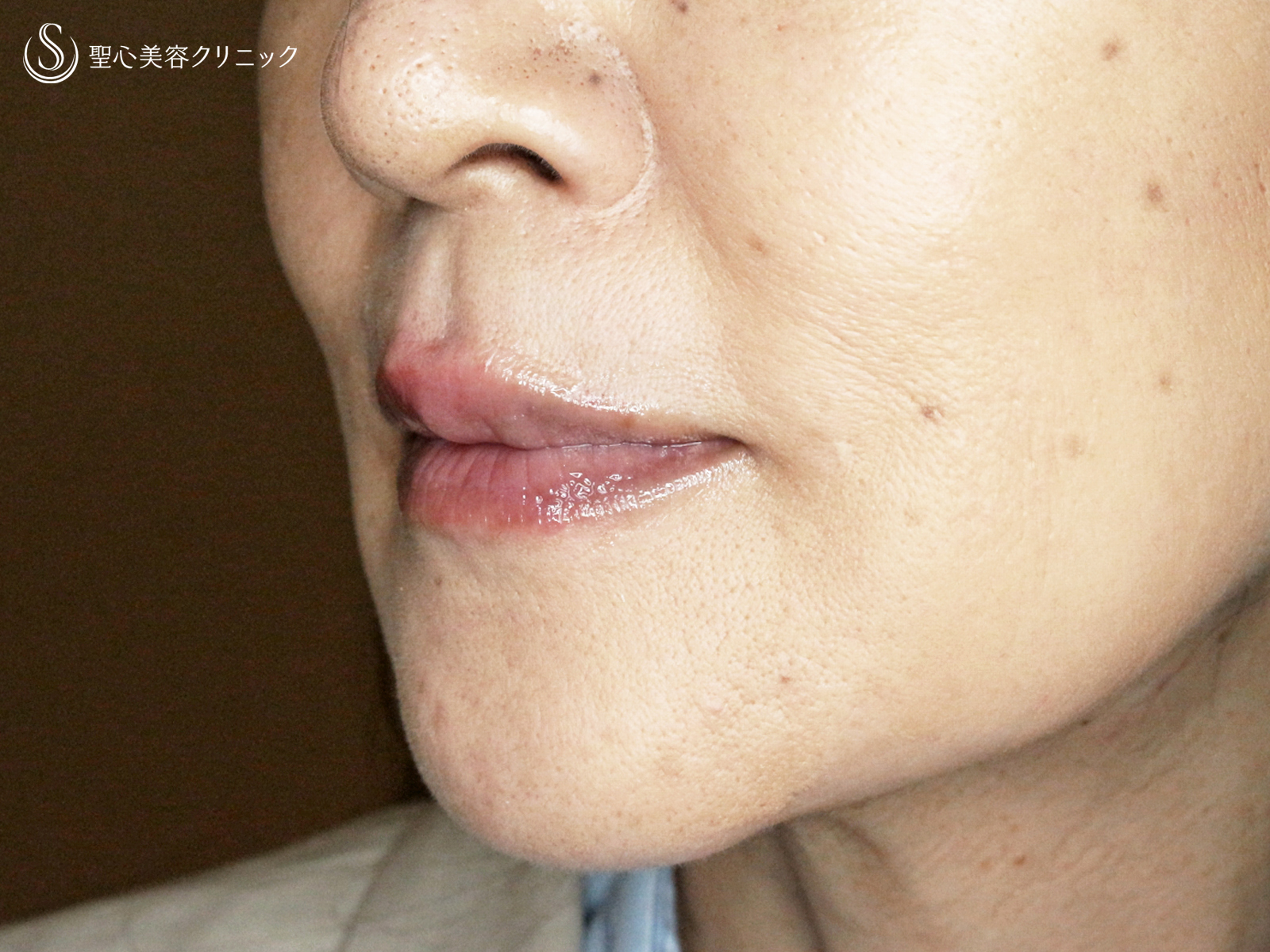 【60代女性・口元の若返り】スマイルリップ「ヒアルロン酸注入」（処置直後） After 