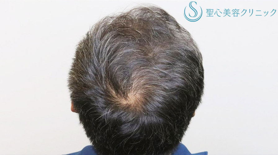 【60代男性・毛髪治療の長期経過】プレミアムグロースファクター再生療法＋デュタステリドAV内服（8ヶ月後） After 