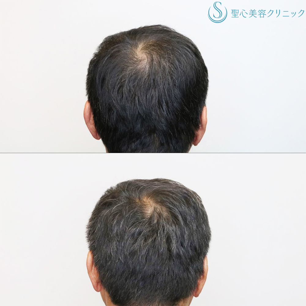 【60代男性・毛髪治療の長期経過】プレミアムグロースファクター再生療法＋デュタステリドAV内服（8ヶ月後） After 