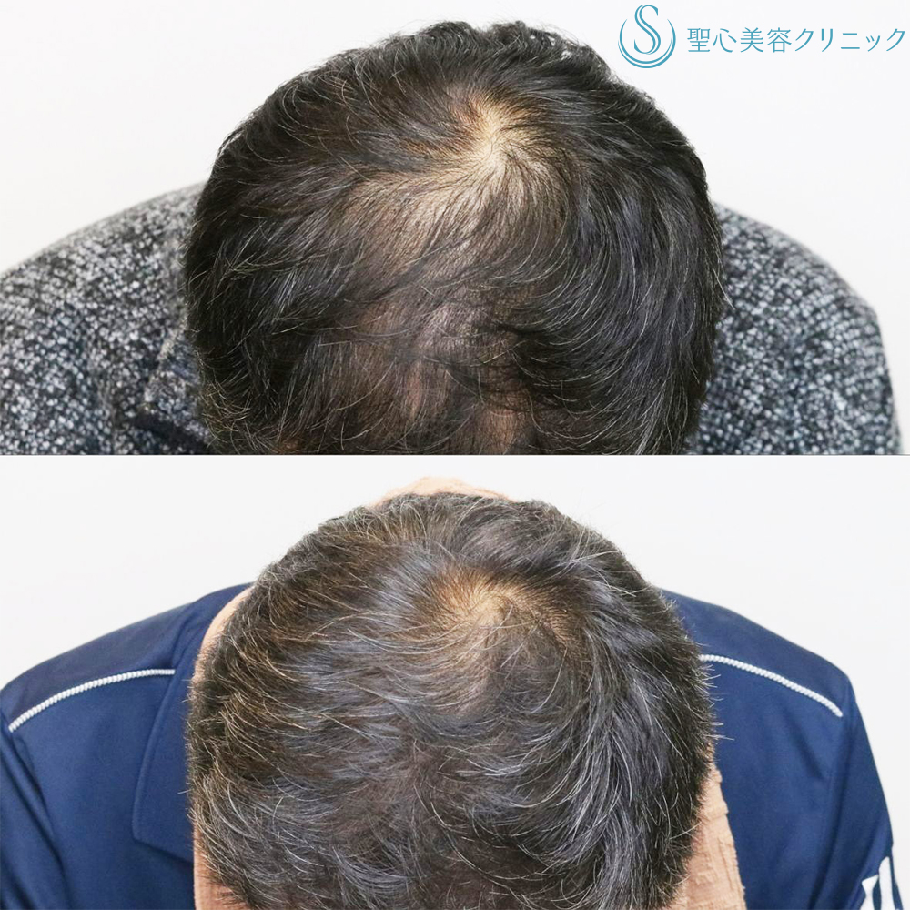 【60代男性・毛髪治療の長期経過】プレミアムグロースファクター再生療法＋デュタステリドAV内服（8ヶ月後） After 