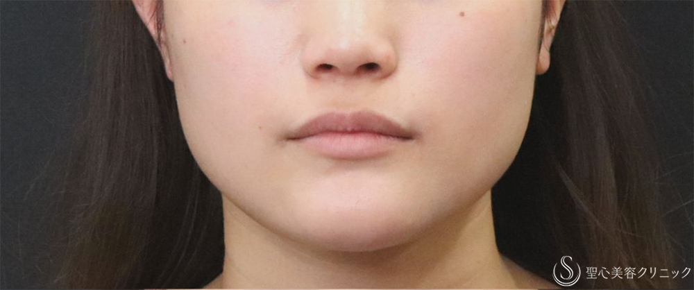 【20代女性・エラの張り】​エラボトックス（2回注射）（3ヶ月後） Before 