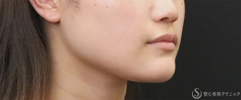 【20代女性・エラの張り】​エラボトックス（2回注射）（3ヶ月後） Before 