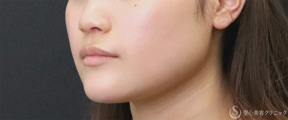 【20代女性・エラの張り】​エラボトックス（2回注射）（3ヶ月後） Before 