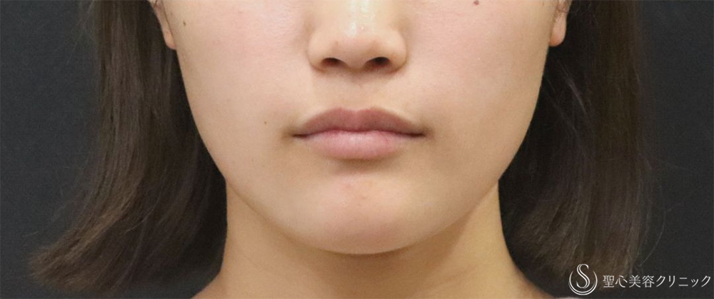 【20代女性・エラの張り】​エラボトックス（2回注射）（3ヶ月後） After 