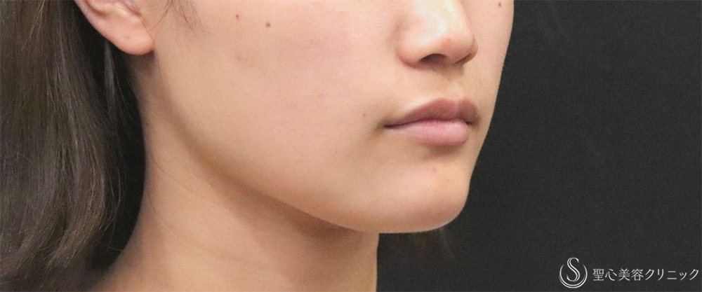 【20代女性・エラの張り】​エラボトックス（2回注射）（3ヶ月後） After 
