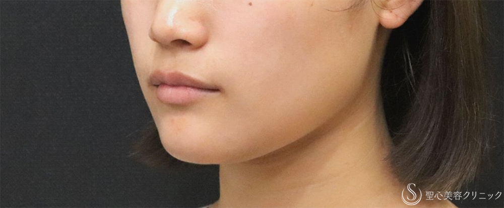 【20代女性・エラの張り】​エラボトックス（2回注射）（3ヶ月後） After 